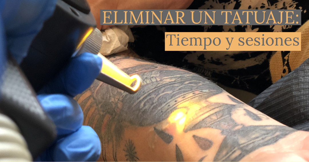 Eliminar un tatuaje: tiempo y sesiones.